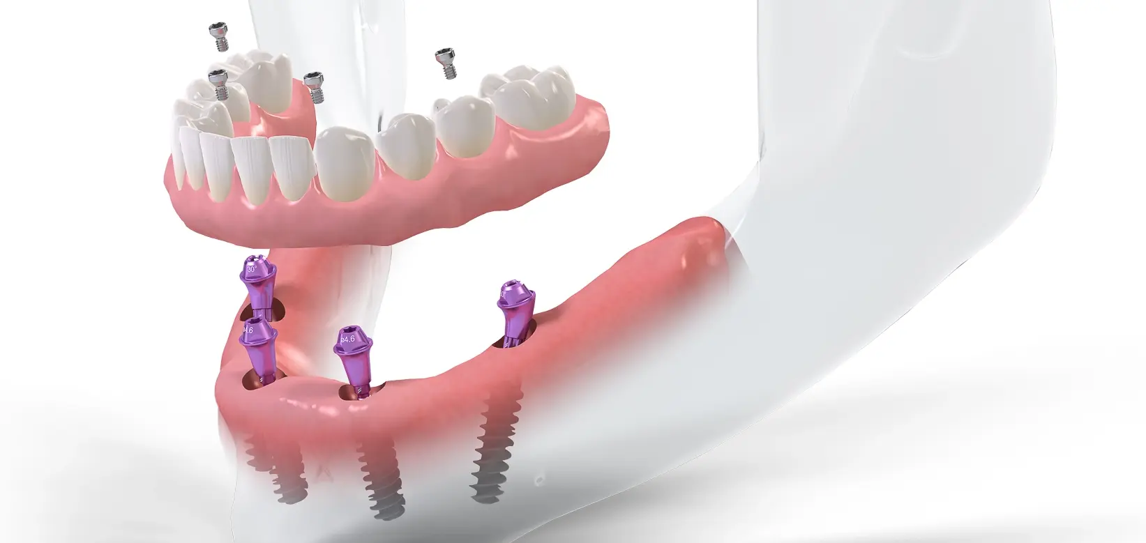 Proteza na implantach
